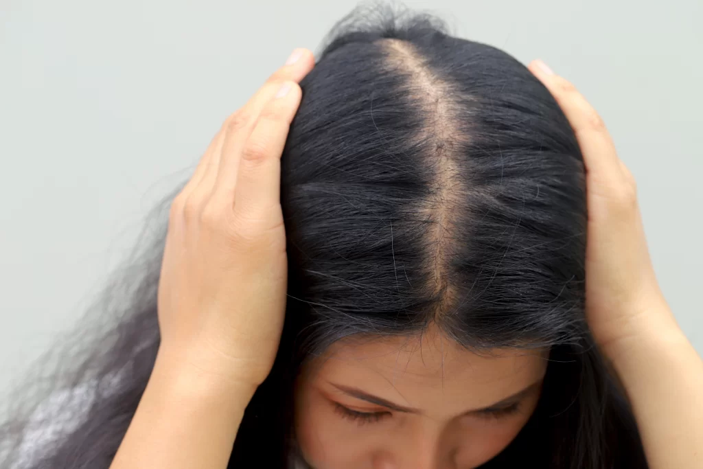 hair loss