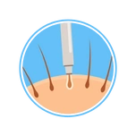 Hair Transplant