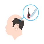 Hair Transplant
