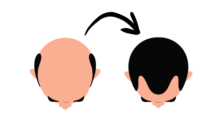 Hair Transplant
